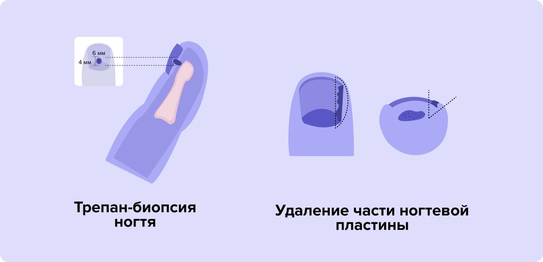Трепан-биопсия ногтя