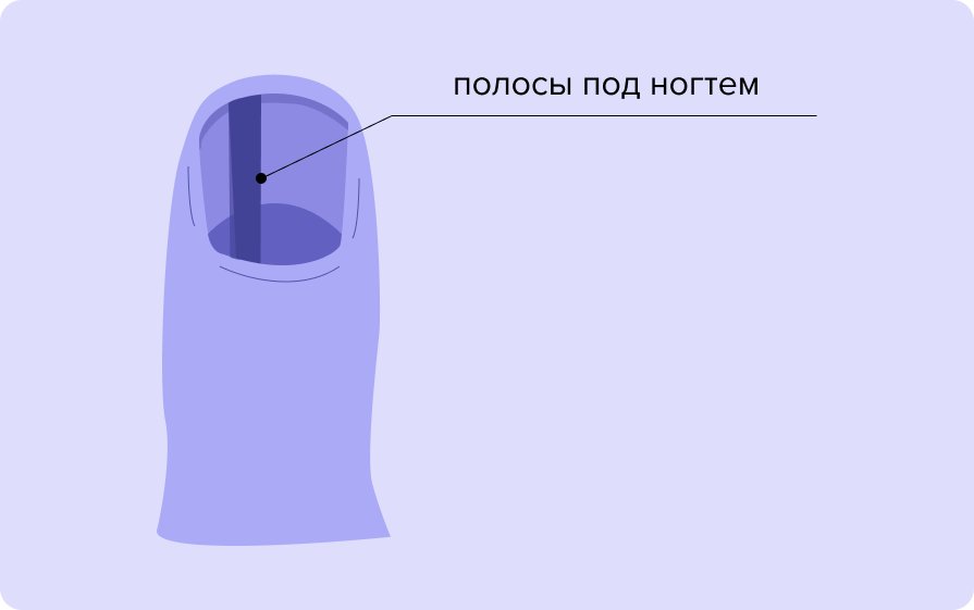 полосы под ногтем